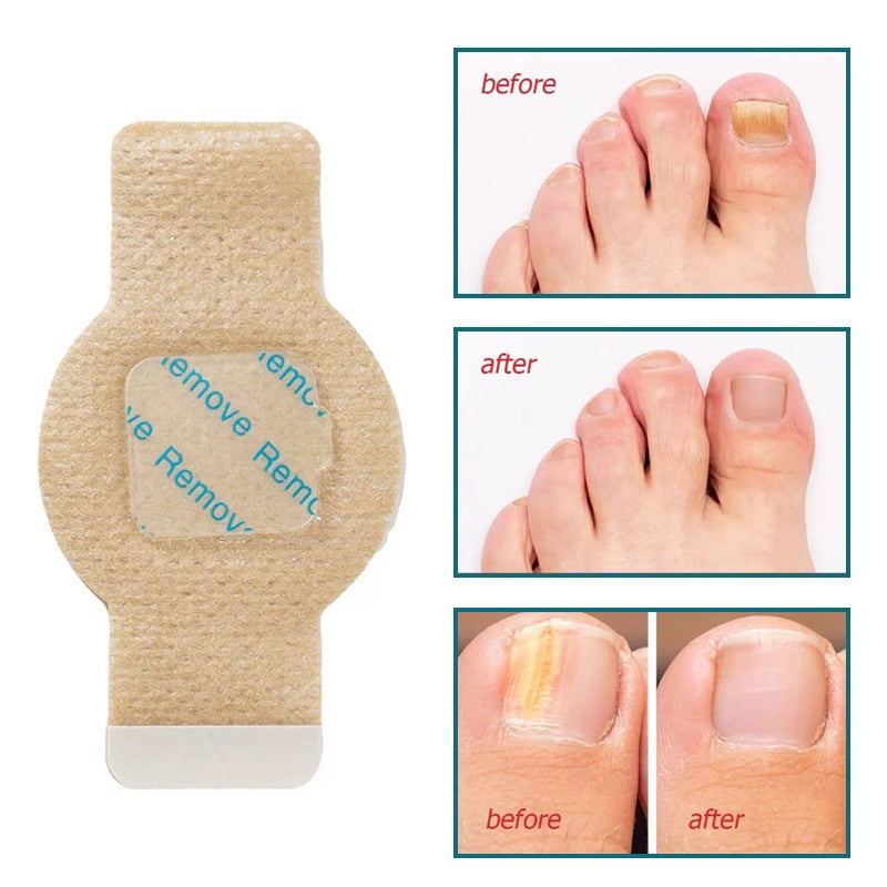 Fungal Nail Patch | Toe Protector, Anti-Bacterial Foot Care